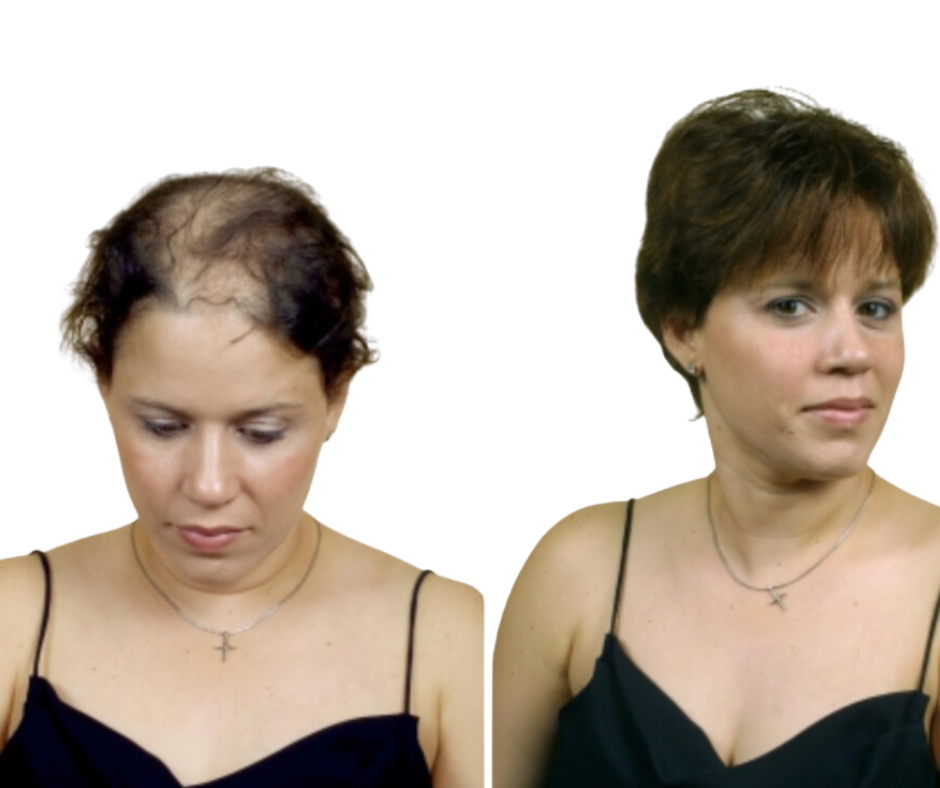 hair replacement for women in Polk County, Florida